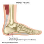 Heel pain  – effective treatment in Hobart